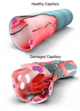 Healthy capillary and damaged capillary