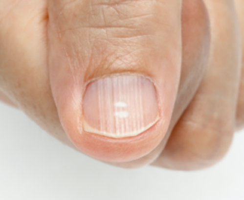 Fingernail abnormalities caused by vitamin deficiency can include white lines, rough texture, and brittleness
